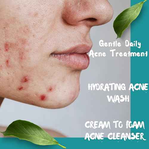 Creamy Acne Foaming Wash 4% Benzoyl Peroxide Face Wash With Hyaluronic Acid & Ceramides Gentle Daily Acne Skin Care 6.76 Fl Oz
