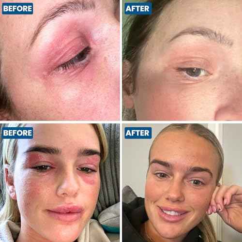 Grahams Natural Face & Eyelid Oil - For Very Dry Skin Around Eye & Face, Eczema & Perioral Dermatitis - Steroid-Free, Hypoallergenic, Non-Comedogenic - 100% Pure - with Argan & Jojoba Oil (1.69 Fl Oz)