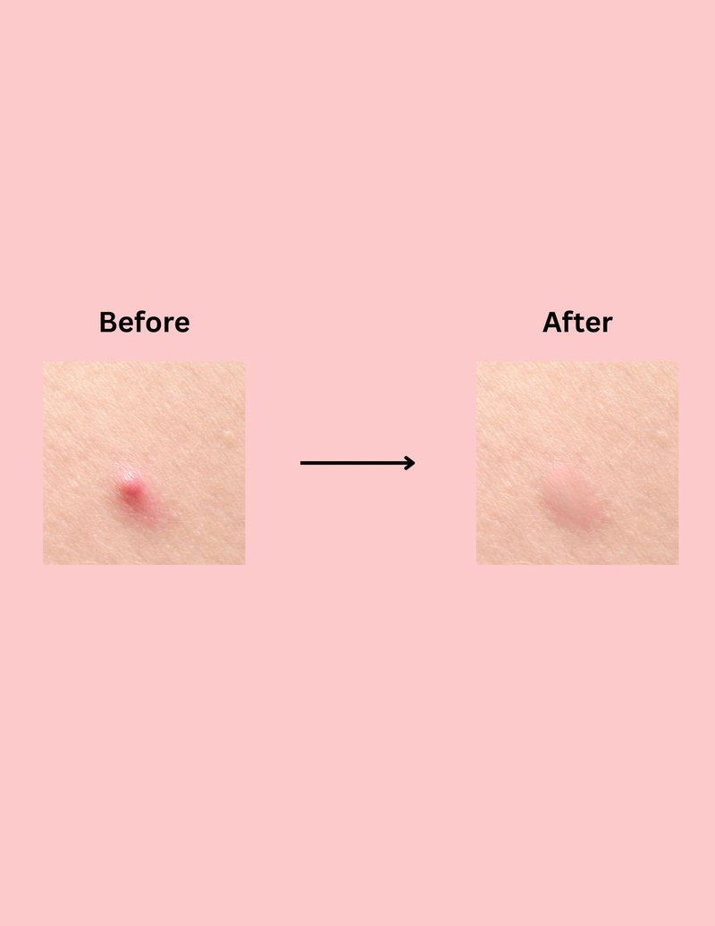 AcneMed Hydrocolloid Acne Patches – Black Star Pimple Stickers for Clear Skin, Cute Spot Treatment, Overnight Blemish Control, 36 Count
