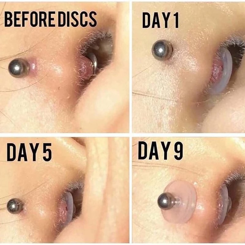 Bloomfall Clear Piercing Disc For Piercing Bump,Pressure Silicone Earrings For Keloids Healing Pads Belly Button Piercing Kit Nose Piercing Bump Treatment (7MM 100PCS)