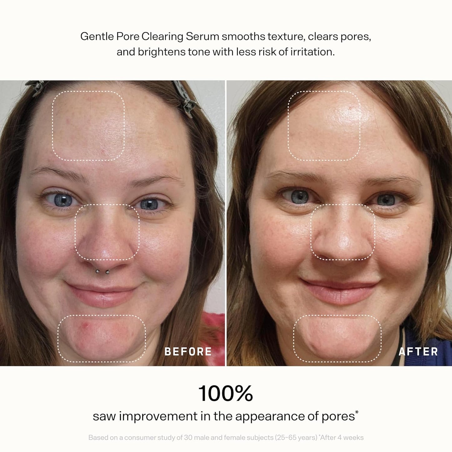 Versed Skin Refine Pore Clearing Serum - Exfoliating Facial Serum with Salicylic & Mandelic Acid | Vegan, 30 ml / 1 fl oz