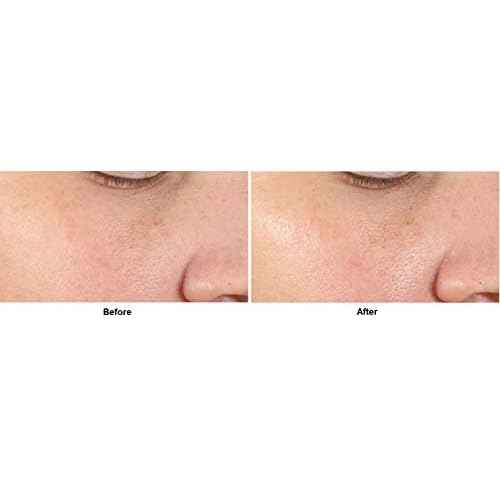 Dr. Dennis Gross Alpha Beta¢ç Pore Perfecting & Refining Serum: for Enlarged, Clogged Pores with Excessive Oil, 1.0 fl oz