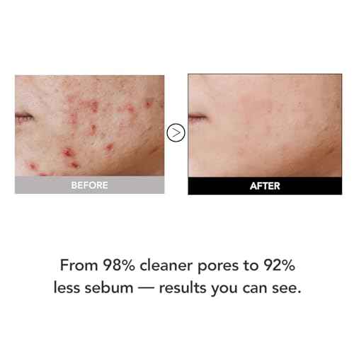 98% Reduction in Pore Impurities & 92% Less Sebum ? Improves Blackheads & Whiteheads by 36% ? Soothes & Strengthens Skin Barrier with D-Panthenol ? Korean Skincare Best Cleansing Foam