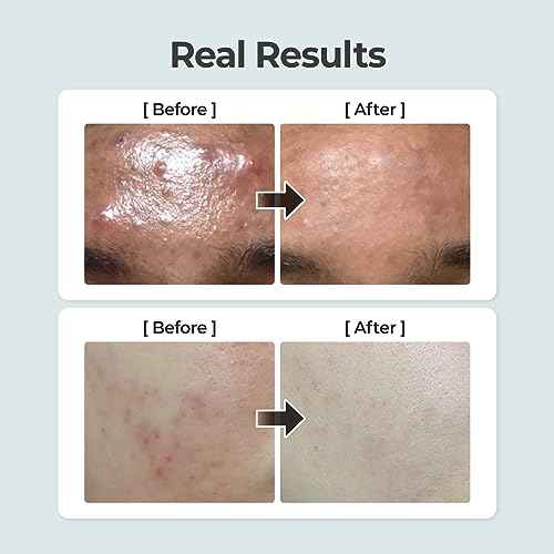 numbuzin No.1 Toner | Pure-Full Calming Herb Toner | Breakouts, Redness, Excess Oil Control | Centella Asiatica, Heartleaf, Licorice Root | Acne-Prone, Sensitive Skin | 10.14 fl. oz.