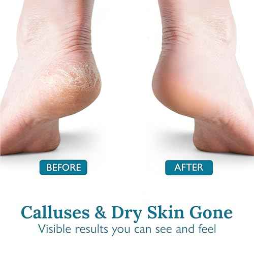 Gilden Tree Foot Callus Remover Kit - 40% Urea Cream & Handmade Terra-Cotta Pumice Stone for Feet - Callus Remover for Feet with Shea Butter & Aloe Vera - Cracked Heel Treatment & Moisturizer
