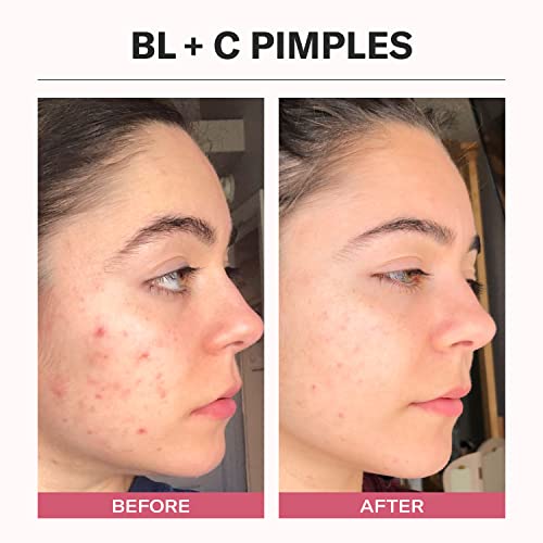 Odacit? Acne Serum Concentrate for Face, Pore Cleanser Facial Oil for Pimples with Black Cumin + Cajeput - Purifying Facial Serum with Vitamin A & Natural Ingredients - 0.17 Fl. Oz