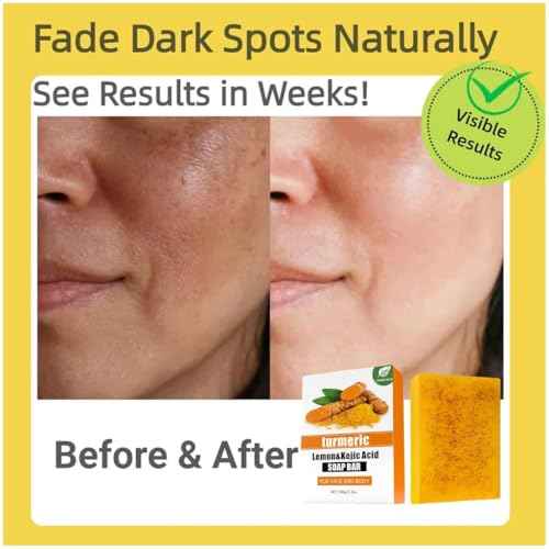 Kojic Acid & Turmeric Soap Bar for Dark Spot removal - Skin Lightening Soap with Vitamin C, Retinol, Shea Butter & Lemon Oil - for Face, Body, Underarms - SLS Free, for Oily & Dry Skin