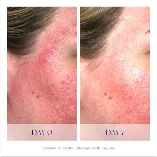 iS CLINICAL Pro-Heal Serum Advance+ - Antioxidant-Rich Vitamin C Serum, Calms Sensitivity & Irritation, Helps Redness, Anti-Aging
