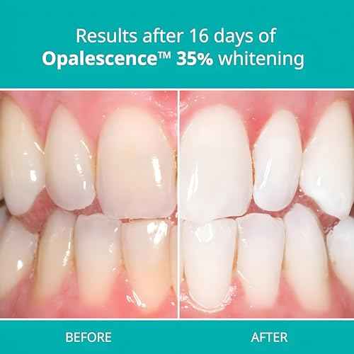 Opalescence PF 35% Unflavored (8 Syringes) Teeth Whitening Refill Kit Carbamide Peroxide. Made by Ultradent, Tooth Whitening Refill Syringes A-5197-4