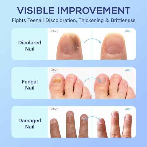Toenail Fungus Treatment Extra Strength: 25% Undecylenic Acid Toe & Fingernail Fungus Renewal - Nail Fungus Treatment Kit with Brush & File - For Ingrown Nails & Discoloration