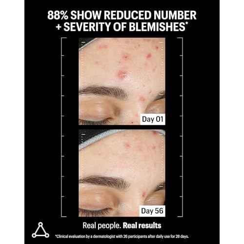 Allies of Skin Azelaic & Kojic Clarifying Face Serum | Clinically Proven for Acne & Blemish Prone Skin |10% Azelaic Acid Treats Pigmentation and Redness | Targets Pores & Uneven Skin Texture (1 Fl oz)
