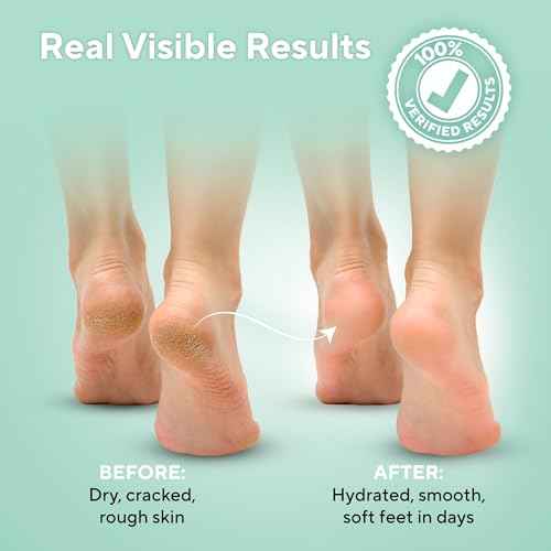 Lavinso Urea Cream 40 Percent for Feet with Maximum Strength - Foot Cream for Calluses and Dry Cracked Heels - Rough Skin Repair for Men and Women