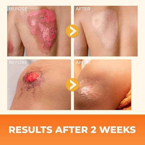 ABERA Scar Cream (Upgrade) - Skin Regeneration & Repair Cream - Heals Wounds, Promotes New Skin Formation, Soothes Scratches, Eczema, and Damaged Areas (Set 2) (1.41 Oz Per Item)