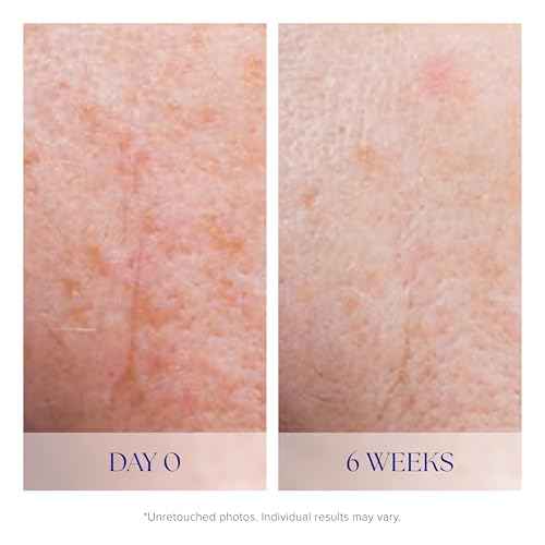 iS CLINICAL Active Serum - Helps visibly even skin tone, Excellent for acne-prone skin, Anti-Aging, Face Serum