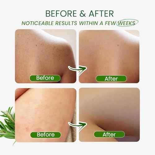 Tea Tree Antifungal Body Wash ? Soothes Folliculitis, Acne, Jock Itch, Athlete¡¯s Foot, Ringworm, Tinea Versicolor, Body Odor, Eczema & Dermatitis-Prone Skin