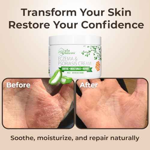Wild Naturals Eczema & Psoriasis Cream for Dry, Itchy Skin ? Eczema Relief for Adults & Kids ? Moisturizing Psoriasis Cream with Manuka Honey