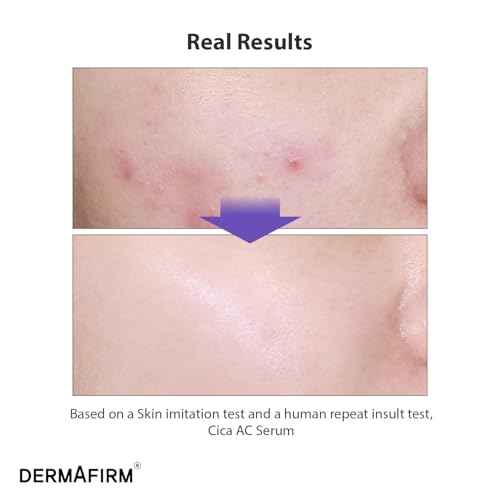 DERMAFIRM CICA AC Serum for Acne-Prone Skin ? Korean Facial Serum with Exosome, Centella Asiatica, Niacinamide, Salicylic Acid & Vitamin B3 ? Hydrating & Calming, 1.01 fl oz