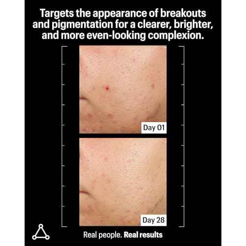 Allies of Skin Azelaic & Kojic Clarifying Face Serum | Clinically Proven for Acne & Blemish Prone Skin |10% Azelaic Acid Treats Pigmentation and Redness | Targets Pores & Uneven Skin Texture (1 Fl oz)