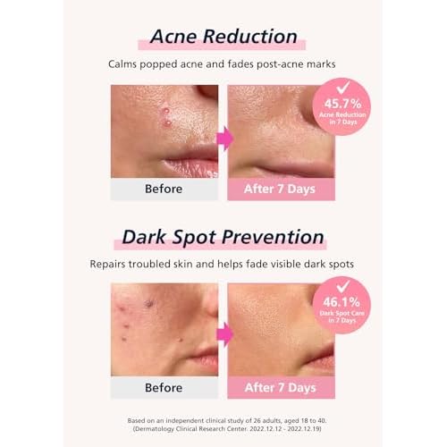 Easyderm Real Calming Patch Pimple Patches, Niacinamide, Hyaluronic Acid, EGF, K-Beauty Skincare | 6 Patches per Pack, 4 Packs (24 Total) Micro Point length : 285¥ìm