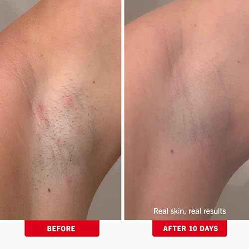 First Aid Beauty - Ingrown Hair Pads with BHA + AHA - Aftershave Treatment Pads to Help Prevent Razor Bumps for Men & Women - Exfoliate Underarms & Bikini Area - Compostable for Daily Use - 60 Pads