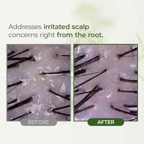 STEAMBASE Tea Tree Scalp Water Scaler | Scalp Exfoliator for Itchy Dry Flaky Scalp, Buildup Remover, Treatment for Excess Sebum Oily Greasy Hair | Korean Hair Care Products, Travel Size, 1.69 fl oz