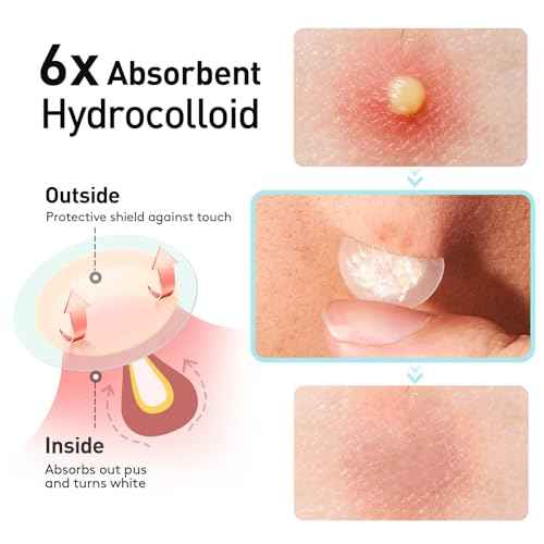 TKTK Pimple Patches, 12mm Invisible Acne Patches for Face with Salicylic Acid, 0.01cm Extra Thin Outer Edge, Hydrocolloid Zit Patch for Pustule, Whitehead, Cystic Acne Spot, 96 Count