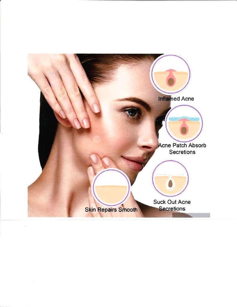 OptiD Pimple Patch, Hydrocolloid Acne Patches for Face, Waterproof & Breathable, Works Day and Night, Shrink Zits & Whiteheads in 1 Use, Nighttime Spot Pimple Stickers (36 Count)