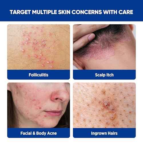 Folliculitis & Acne Treatment Cream ? Salicylic Acid & Herbal Extracts for Scalp, Face, Body & Back ? Soothes Irritated Skin, Redness & Itch Relief ? 100g (Pack of 1)