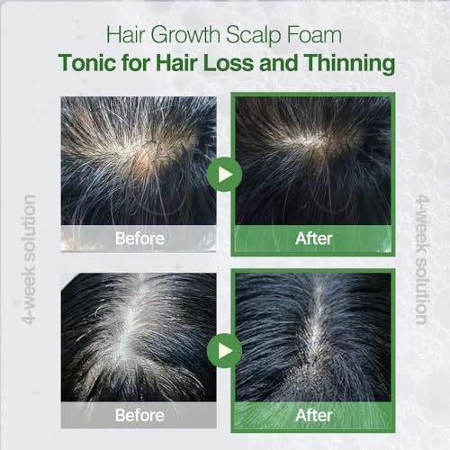ROOTONIX Rosemary Scalp Tonic for Thinning Hair, Leave-In Treatment, K-Beauty Hair Growth Foam with Biotin, Caffeine (3.38oz /100 ml)