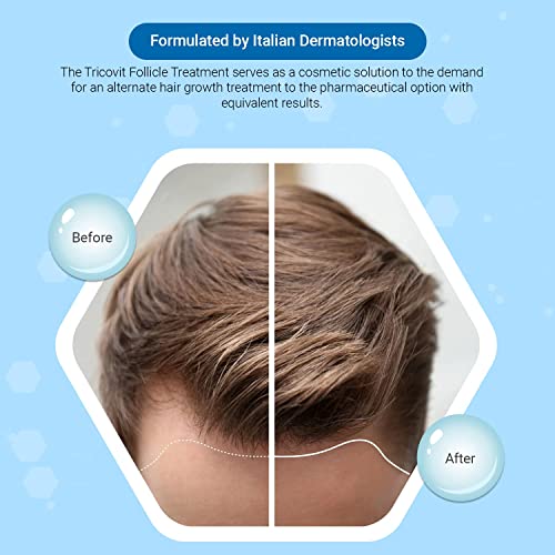 Tricovit Forte Hair Lotion - Hair Growth Serum With Androgen and DHT Blockers For Thinning Hair - Promotes Stronger, Thicker Hair For Men and Women - 5 Ampoules