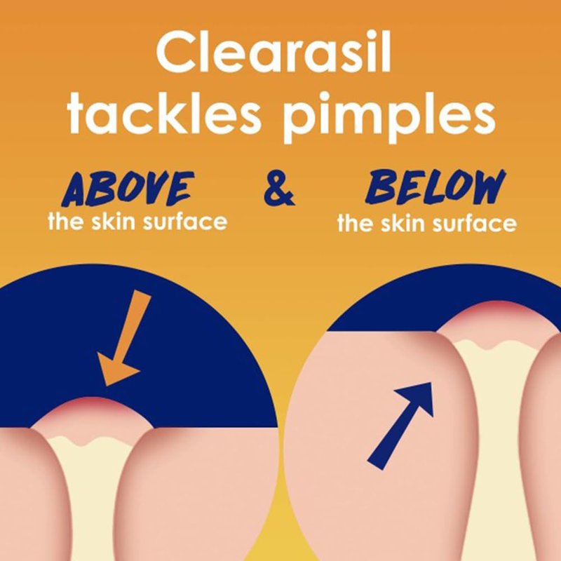 Clearasil Stubborn Acne Control 5in1 Exfoliating Wash, Maximum Strenght with 2% Salicylic Acid Acne Treatment Medicine, Daily Acne Facial Cleanser 6.78 fl oz