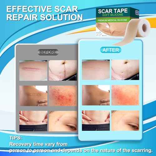Medical Grade Silicone Scar Tape for Surgical Scars (1.6" x 157" - 4M) Professional Silicone Scar Sheets Scar Treatment for Face Wrinkles, C Section Recovery, Keloid Bump Removal Silicone Scar Patches