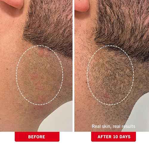 First Aid Beauty - Ingrown Hair Pads with BHA + AHA - Aftershave Treatment Pads to Help Prevent Razor Bumps for Men & Women - Exfoliate Underarms & Bikini Area - Compostable for Daily Use - 60 Pads