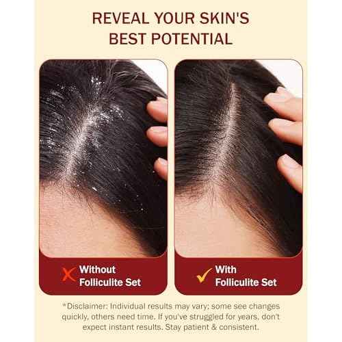 Folliculitis 3-Piece Set - Folliculitis Shampoo, Dry Scalp Serum & Body Spray with Salicylic Acid, Tea Tree Oil & Peppermint Oil - Soothes Itchy Scalp, Razor Bumps & Blemishes by e70