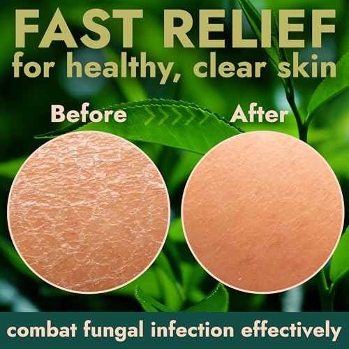 Antifungal Soap | Deep-Cleansing & Exfoliating Bar for Men & Women | Natural Ingredients with Tea Tree & Eucalyptus | Helps Soothe Jock Itch, Ringworm & Athlete¡¯s Foot Pumice Bar Soap