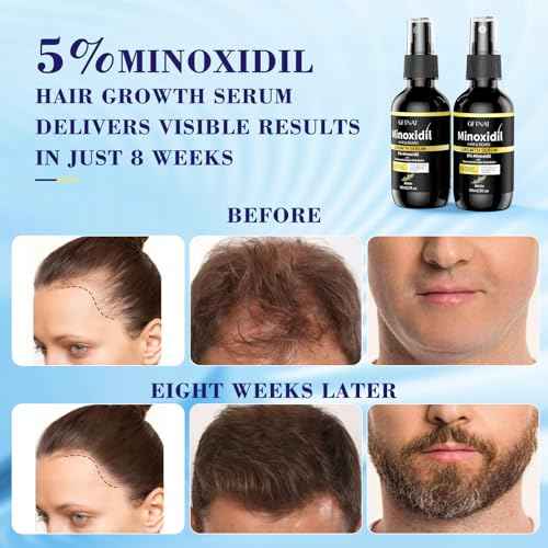 5% Minoxidil Spray for Men and Women with Biotin and Rosemary Hair Growth Serum (Glass Bottle), 5 Percent Minoxidil for Women Spray for Thicker Fuller Hair