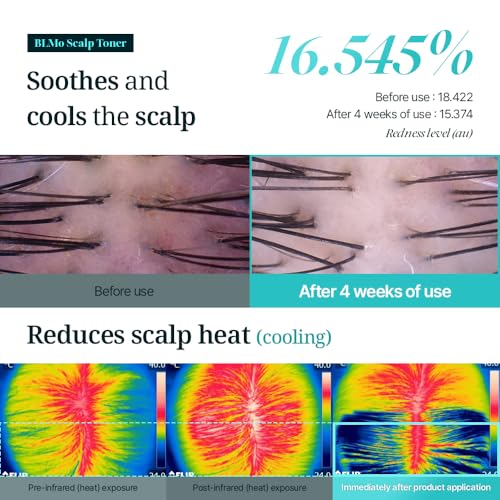 Scalp Serum for Hair Loss & Thinning with Massaging Tips | Clinically Proven | Thickens & Accelerates Hair Growth | Supports DHT Balance | Korean Hair Care | Low Irritation, Drug-Free | 4.05 fl.oz