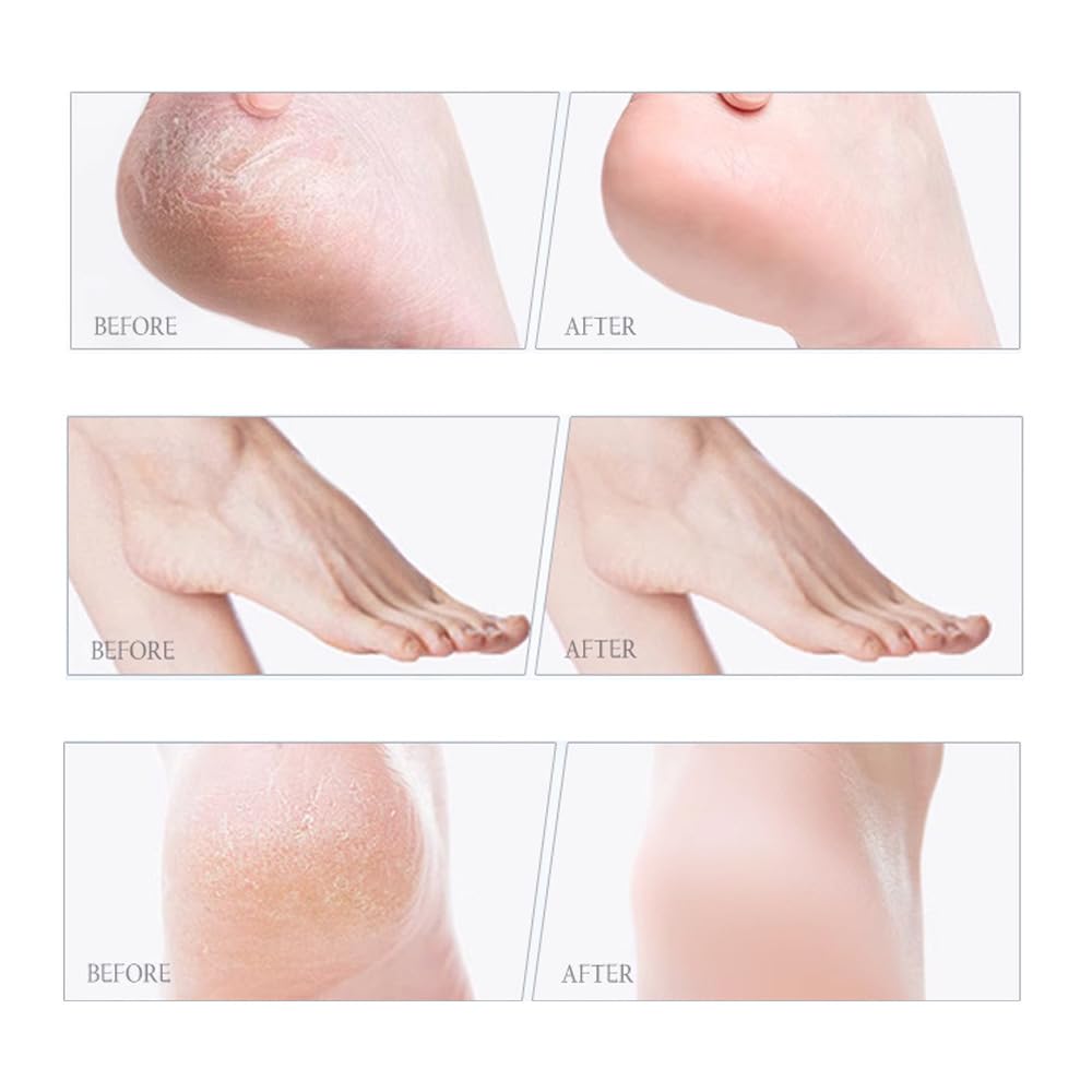 LmiiSanHoo 60% Urea Hydrating and 2% Salicylic Acid Foot Care Cream, Upgraded Care Cream Repairs and Hydrates Dry and Cracked Feet and Hand, Moisturising and Relieves Foot Cream for Man and Women (1)
