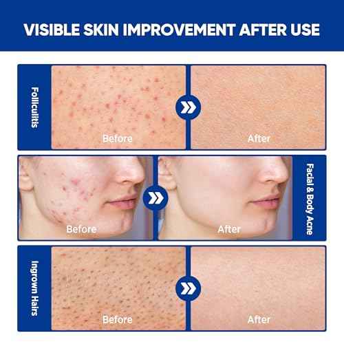 Folliculitis & Acne Treatment Cream ? Salicylic Acid & Herbal Extracts for Scalp, Face, Body & Back ? Soothes Irritated Skin, Redness & Itch Relief ? 100g (Pack of 1)