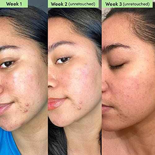 Sand & Sky Oil Control Blemish Clearing Clay Face Mask with Salicylic Acid & Niacinamide - Blemish Fighting Mask, Minimizes Redness, Tightens Pores