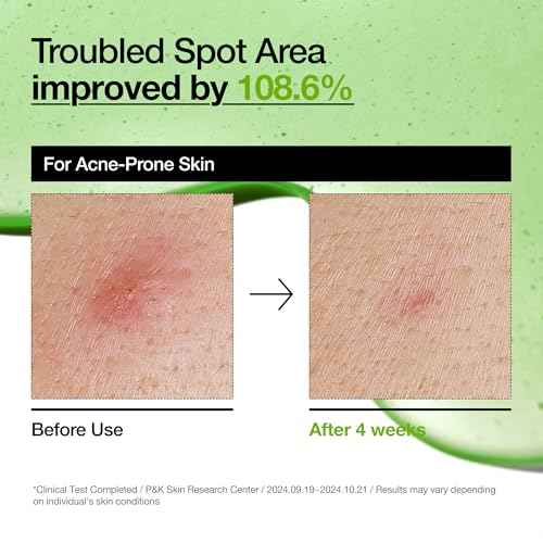 Anua Azelaic Acid 10 Hyaluron Redness Soothing Serum, Facial Serum for Troubled & Sensitive Skin, Breakouts, Hyaluronic Acid, Niacinamide, Spot Care, Natural Color, Korean Skincare (30ml/ 1.01 fl oz.)