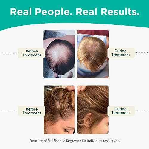 Shapiro MD Hair Growth Experts Shampoo and Leave in Conditioner, DHT Fighting Vegan Formula for Thinning Hair Developed by Dermatologists, Experience Healthier, Fuller Thicker Looking Hair, 1 Month