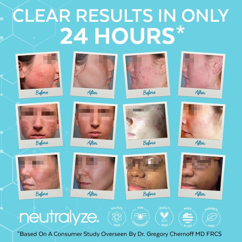 Neutralyze Moderate to Severe Acne Face Wash 2.0 - Maximum Strength 2% Mandelic Acid & 2% Salicylic Acid Facial Cleanser for Acne Prone Skin - Suitable for All Skin Types, Teens & Adults (5 FL OZ)