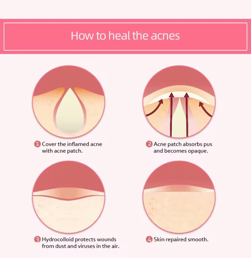 Acne Pimple Patches (144 Count) – Hydrocolloid Acne Patches for Face, Invisible & Waterproof, Fast Absorbing Zit Stickers for Pimples, Blemishes & Whiteheads – Day & Night Treatment