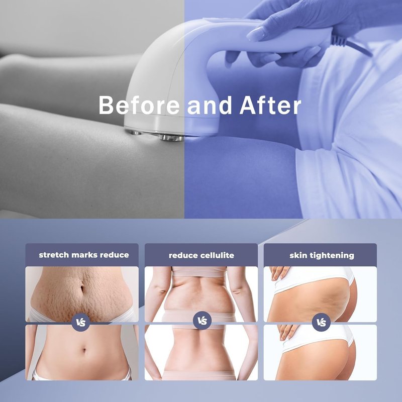 Cellulite Body Device - Radio Frequency Heat Treatment for Smooth Skin