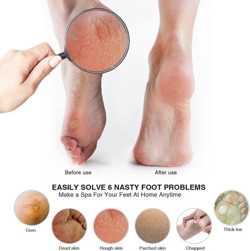 Pumice Stone Foot File (2-Pack), Wooden Handle Foot Scrubber & Callus Remover for Dry, Rough Skin and Corns Pedicure