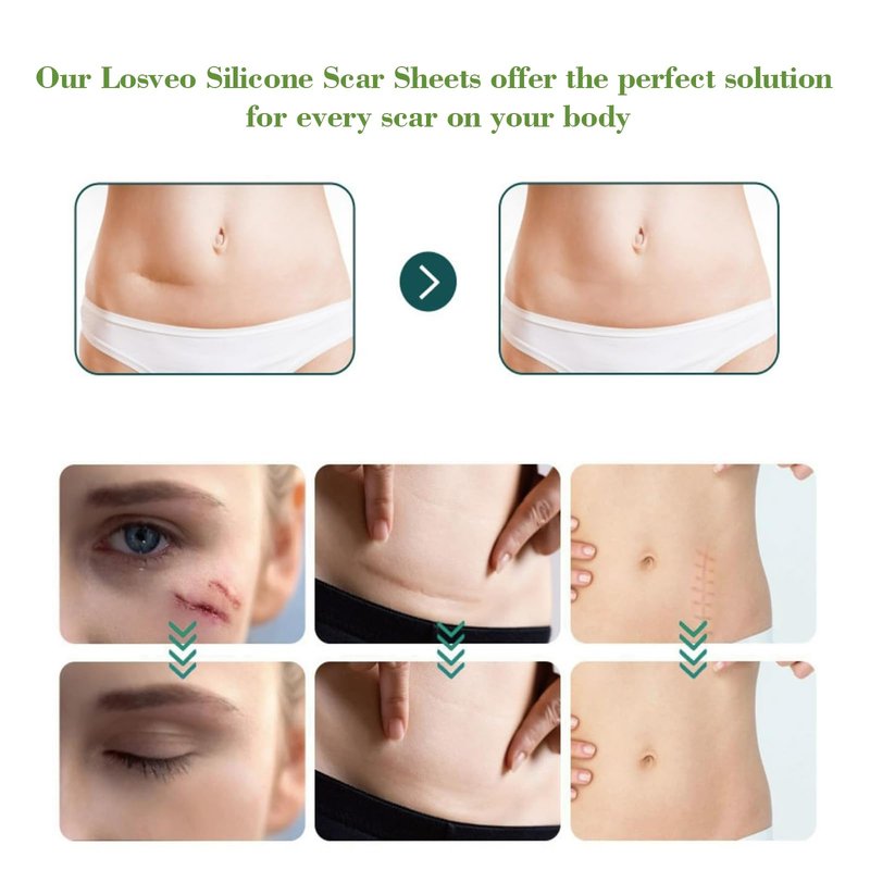 LOSVEO Silicone Scar Sheets For Face Wrinkles, 1.6”x 120”/3m Collagen Scar Tape Strips,Medical Grade Silicone Scar Sheets for Surgical Scars,C-Section, Burn, Scars- Reusable (3m/120 inch)