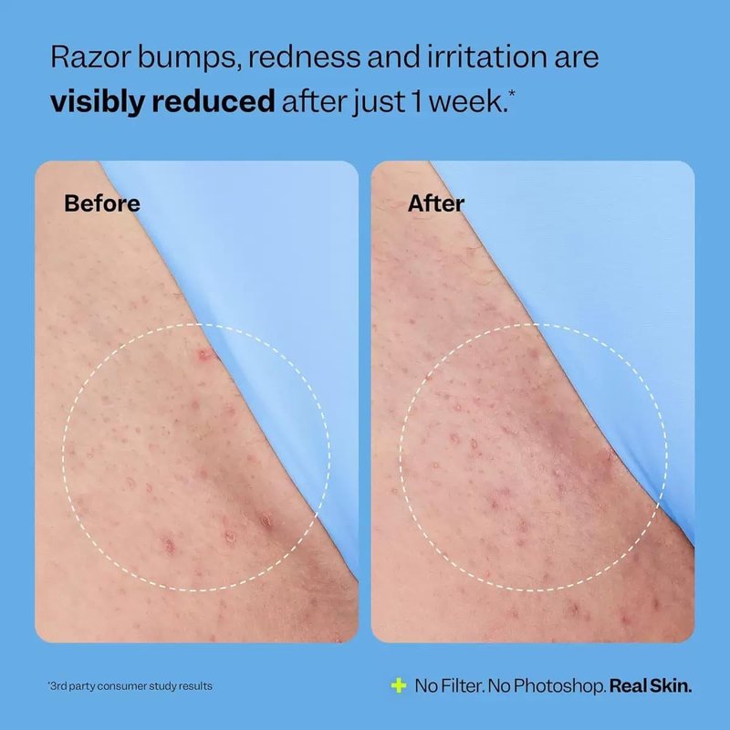 Ingrown Hair Treatment Serum - Smoothing Solution for Razor Bumps & Bikini Line | Soothing Aftercare for Soft Skin