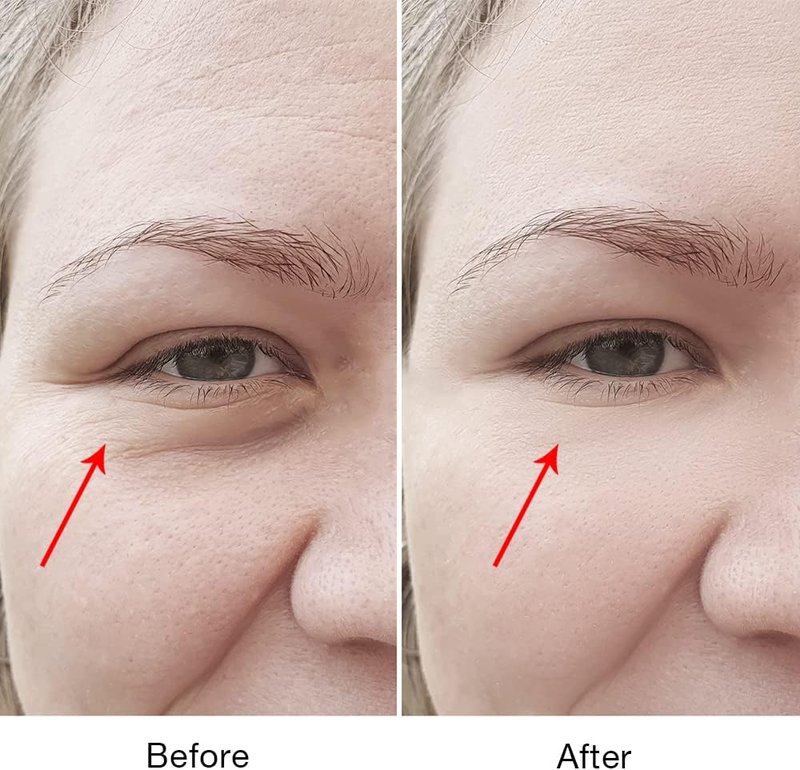 Skiennix 2-in-1 RF Microcurrent Eye Device - Professional Eye Care for Puffiness & Fine Lines