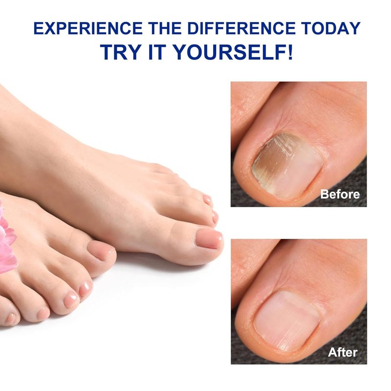 Skiennix Fungal Nail Patches - Extra Strength Toenail Fungus Treatment for Men & Women | 32 Pcs